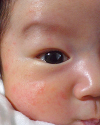 赤ちゃん 顔 ブツブツ 赤ちゃんの発疹は何が原因 新生児 1歳に赤い発疹が出たら